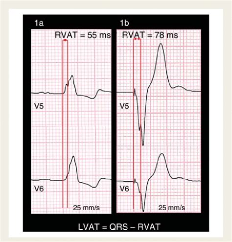 lv pacemaker lead placement|pacing to left ventricular activation time.